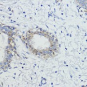 Immunohistochemistry of paraffin-embedded Human mammary cancer using AKT Antibody (1/100 dilution, 40x lens).