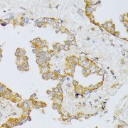 Immunohistochemistry of paraffin-embedded Human lung cancer using ART1 Antibody (1/100 dilution, 40x lens).